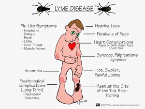 Lyme Disease Treatment Tacoma Washington
