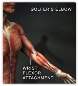 Golfers Elbow Tacoma WA